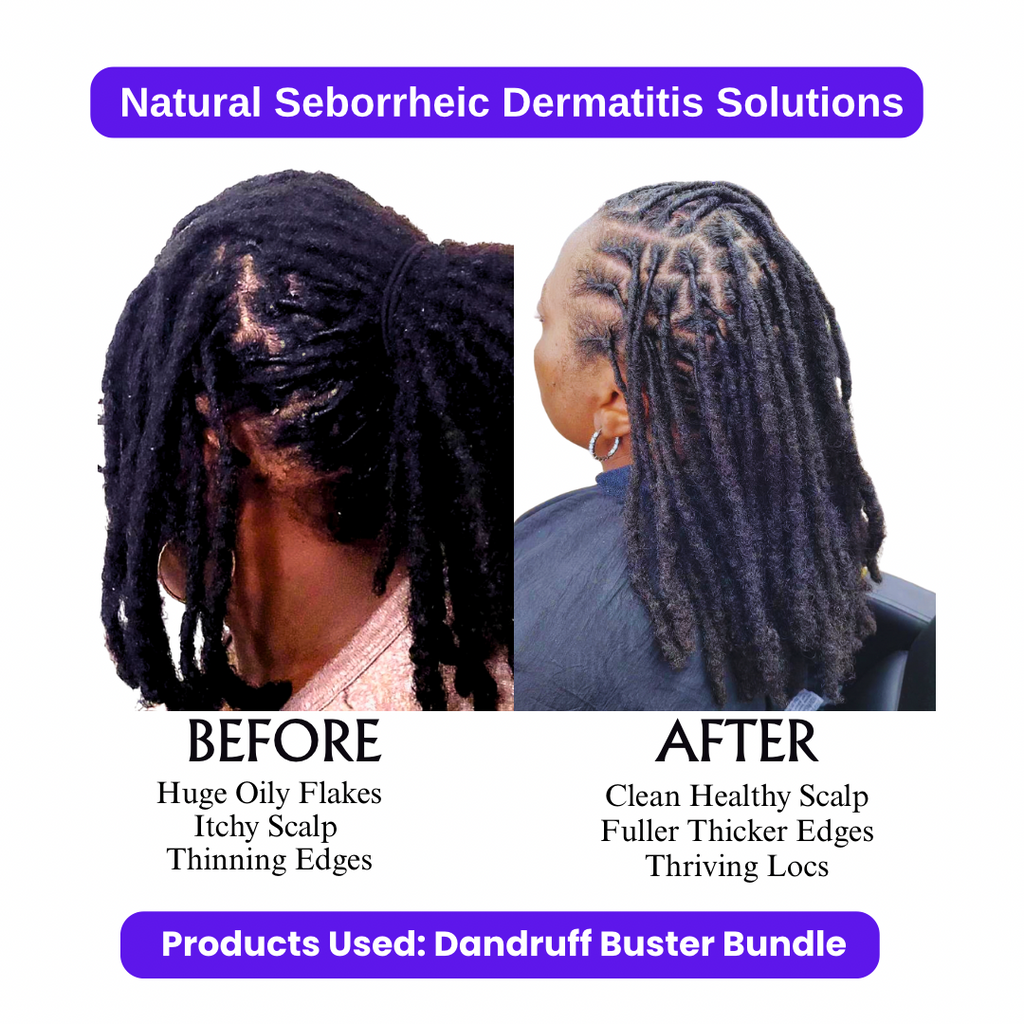 Dandruff Buster Bundle Flower Child Loc Care LLC
