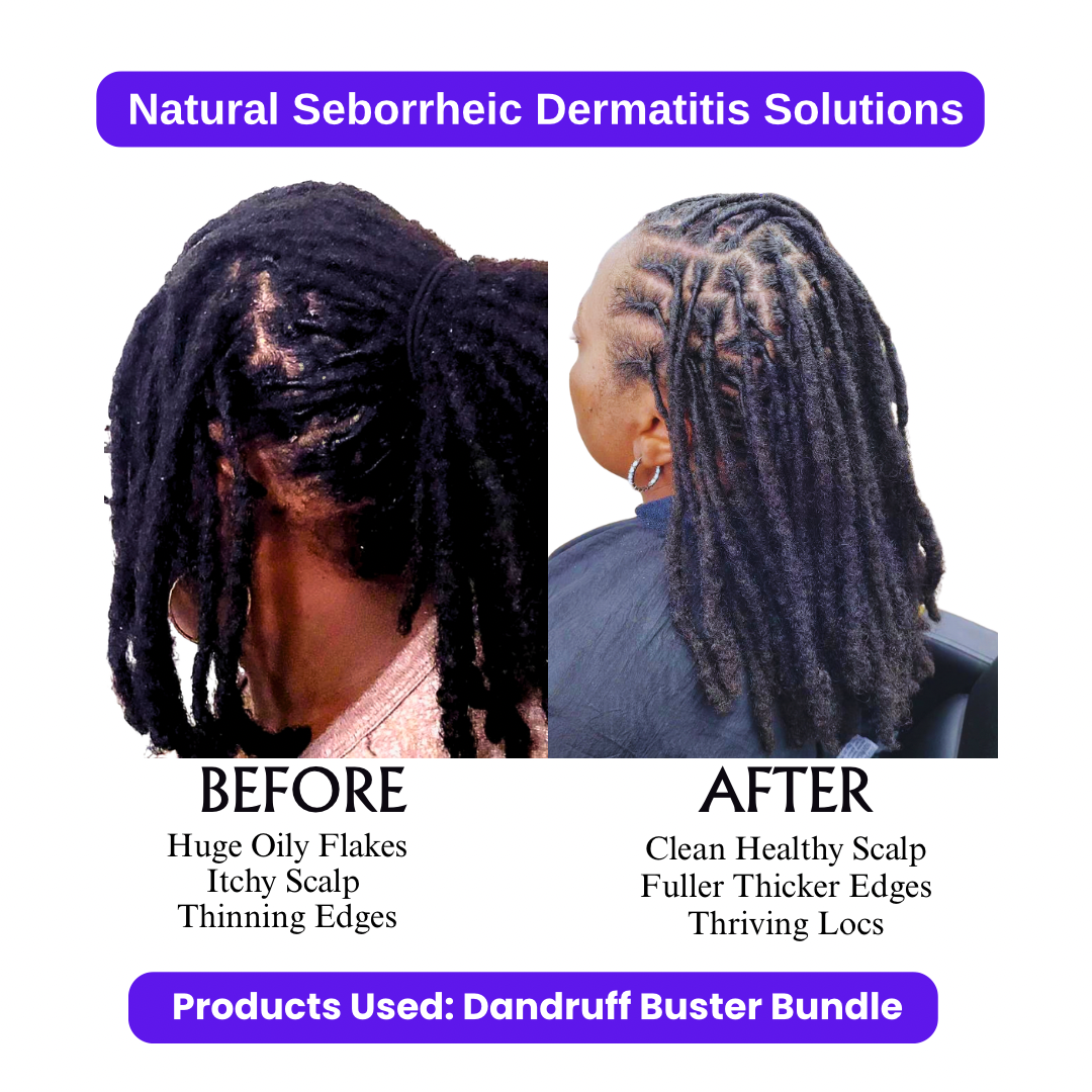 Dandruff Buster Bundle Flower Child Loc Care LLC