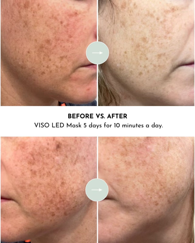VISO - FDA Certified Red Light Therapy Mask Lumara